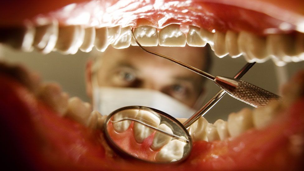 composite veneers for gaps