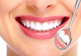 permanent veneers